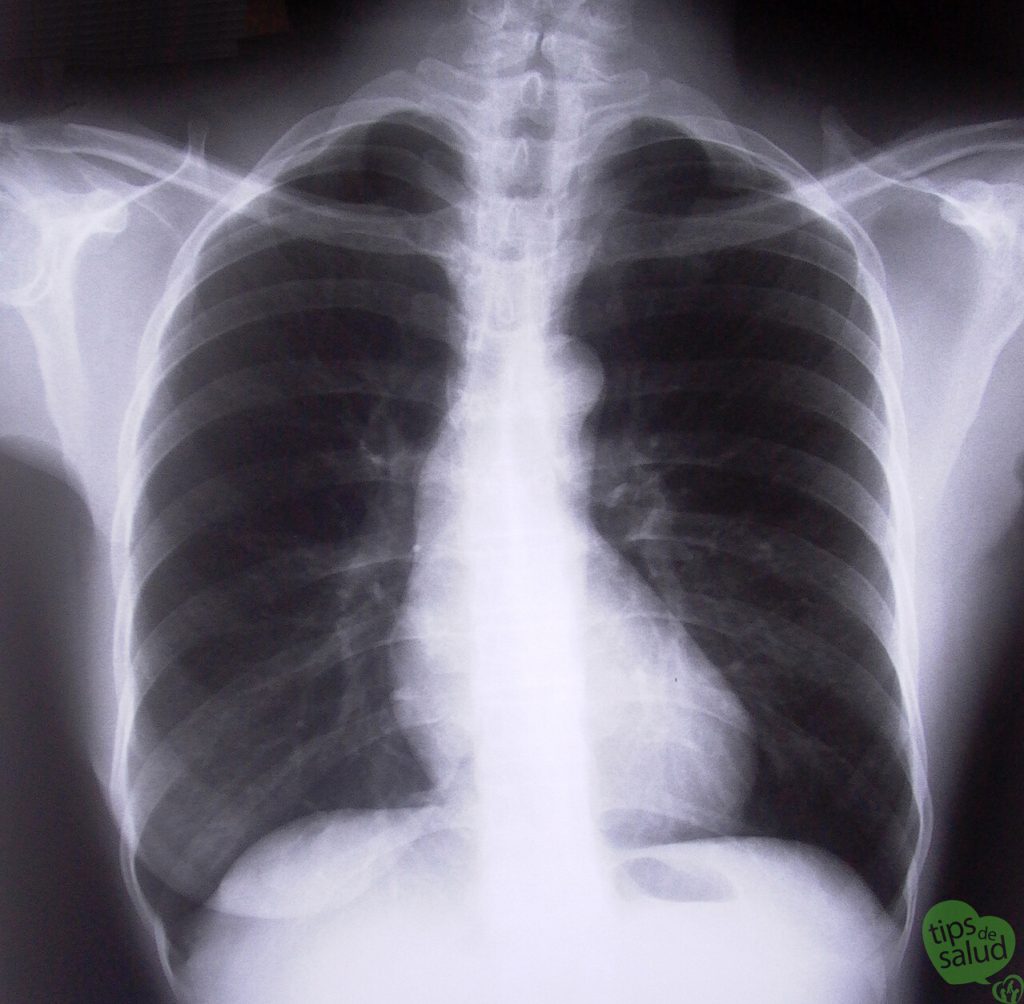 chest-xray-1526779-1279x1254 - Tips de Salud