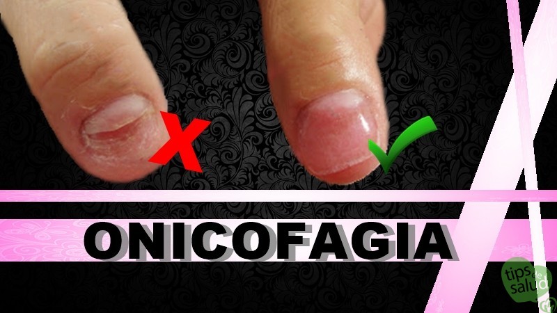 ONICOFAGIA - Tips de Salud Onicofagia