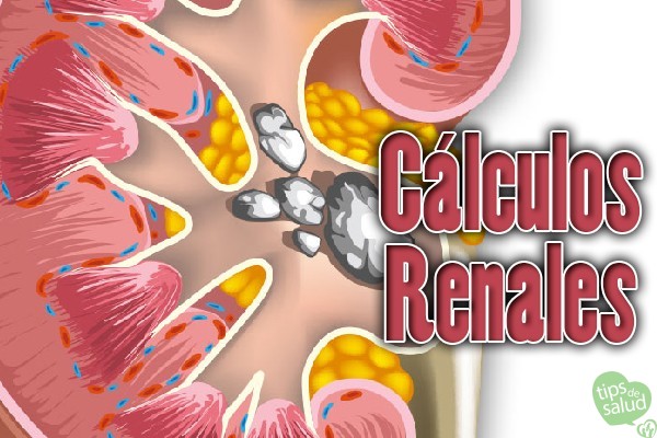 calculos-renales - Tips de Salud Calculos Renales