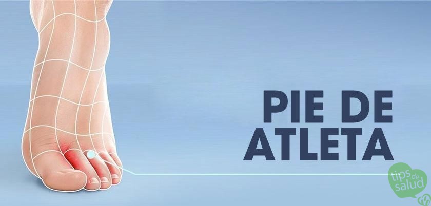 pie-de-atleta - Tips de Salud Pie-de-Atleta
