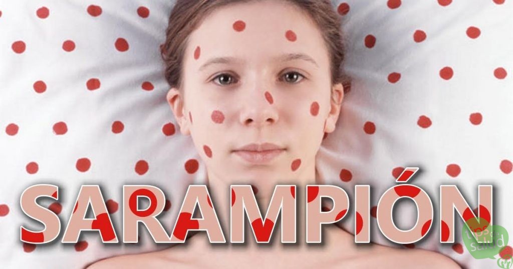 sarampion - Tips de Salud Sarampion