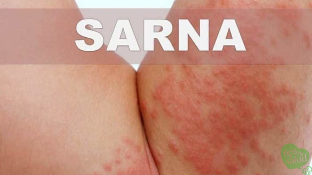 sarna-en-humanos - Tips de Salud Sarna en Humanos