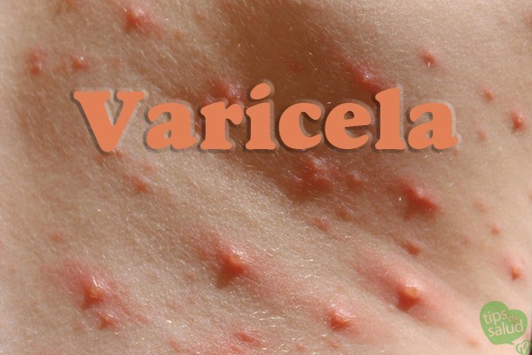 Varicela